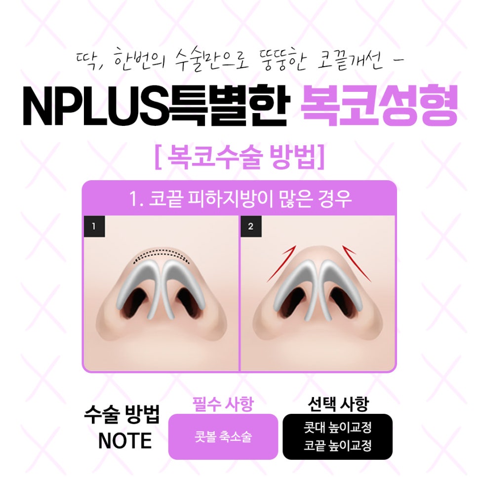 복코수술후기 자연스럽고 예쁜 라인으로 관련 이미지 7