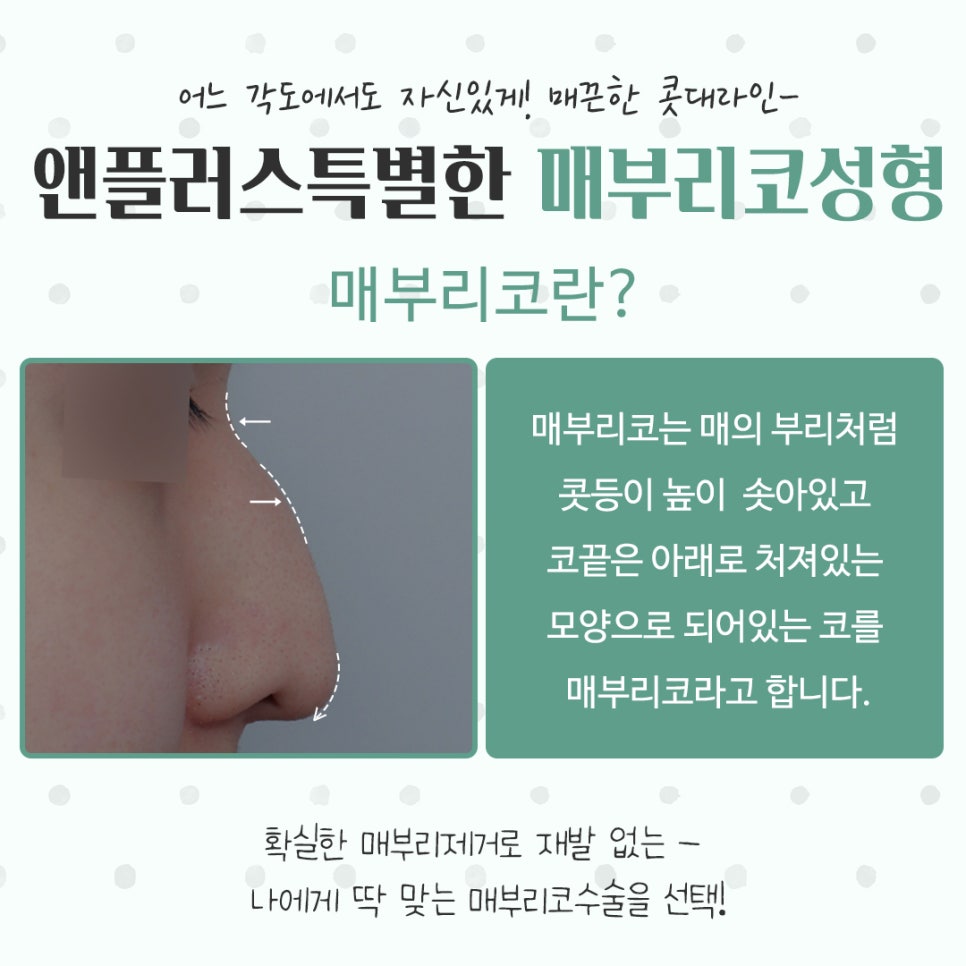 매부리코성형후기 코끝처짐을 개선하여 관련 이미지 3
