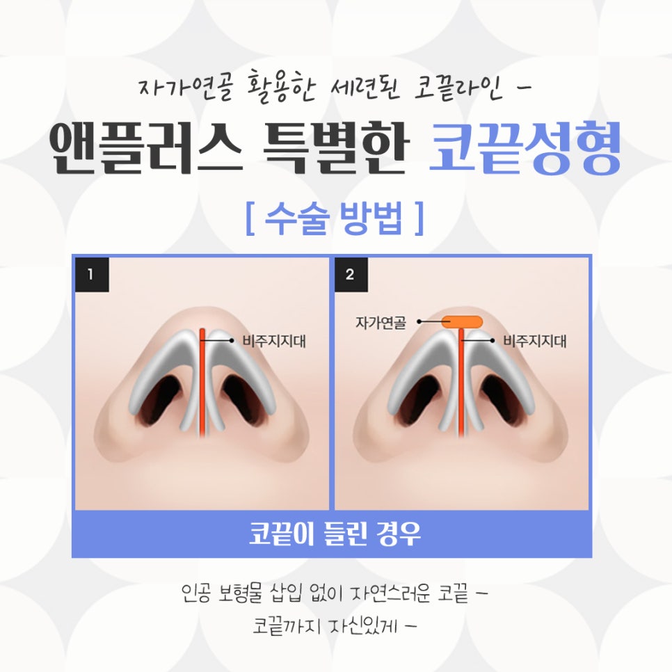 코끝수술에 대해 알아보고 신중하게 관련 이미지 8