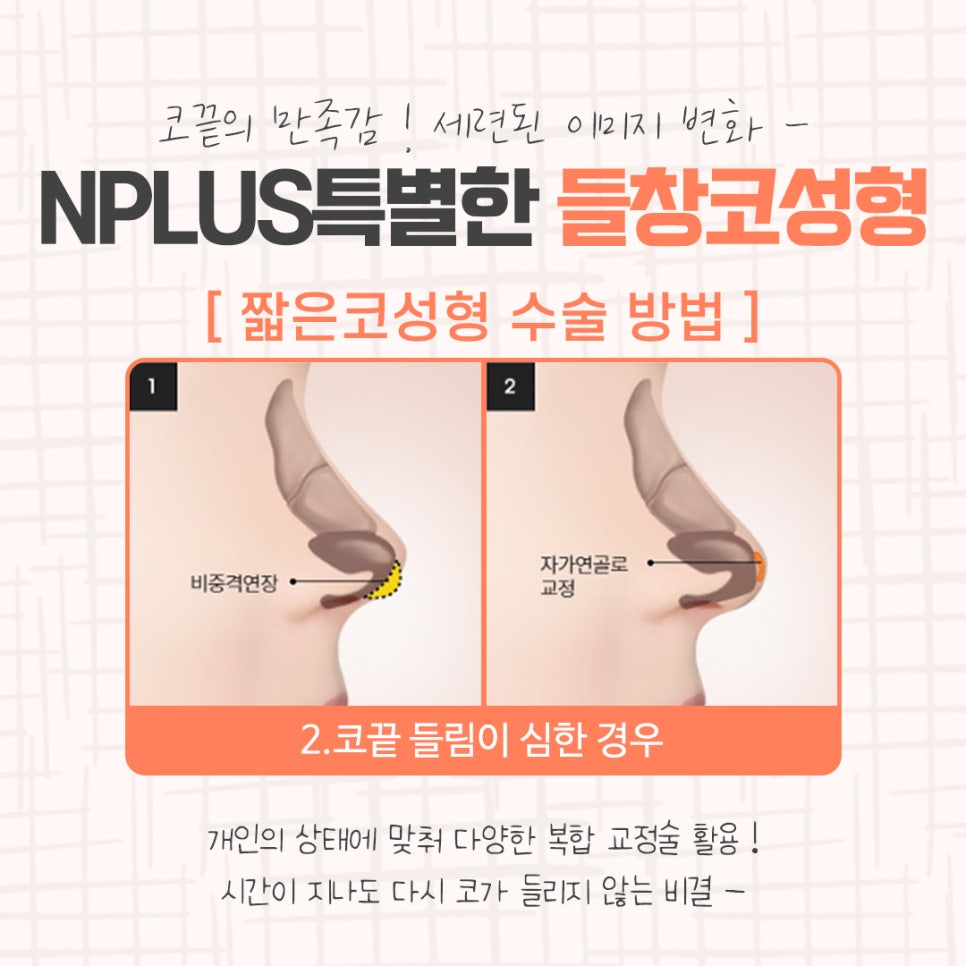 Learn More About Upturned Nose Rhinoplasty in Detail image 8