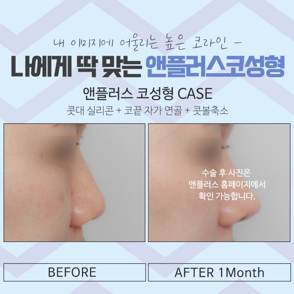 The Importance of Choosing Apgujeong Rhinoplasty image 15
