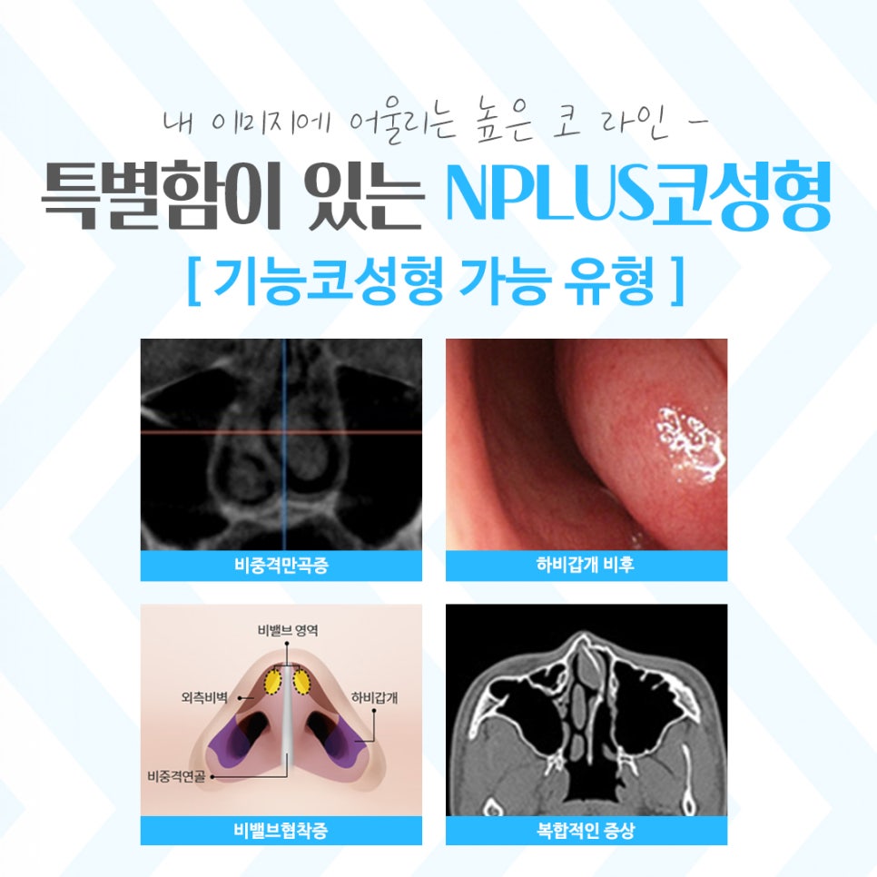 코성형잘하는곳에서 차이를 알아보고 관련 이미지 6
