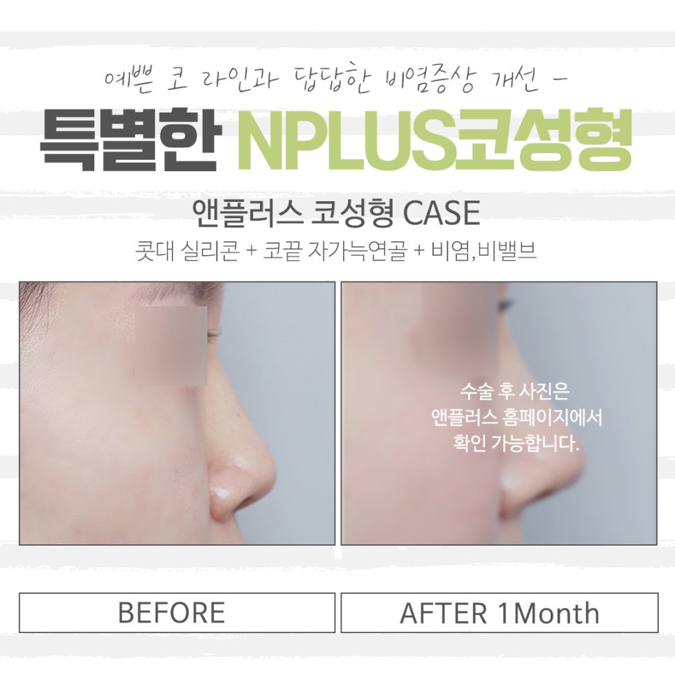 Learn About the Differences in Low Nose Rhinoplasty image 12