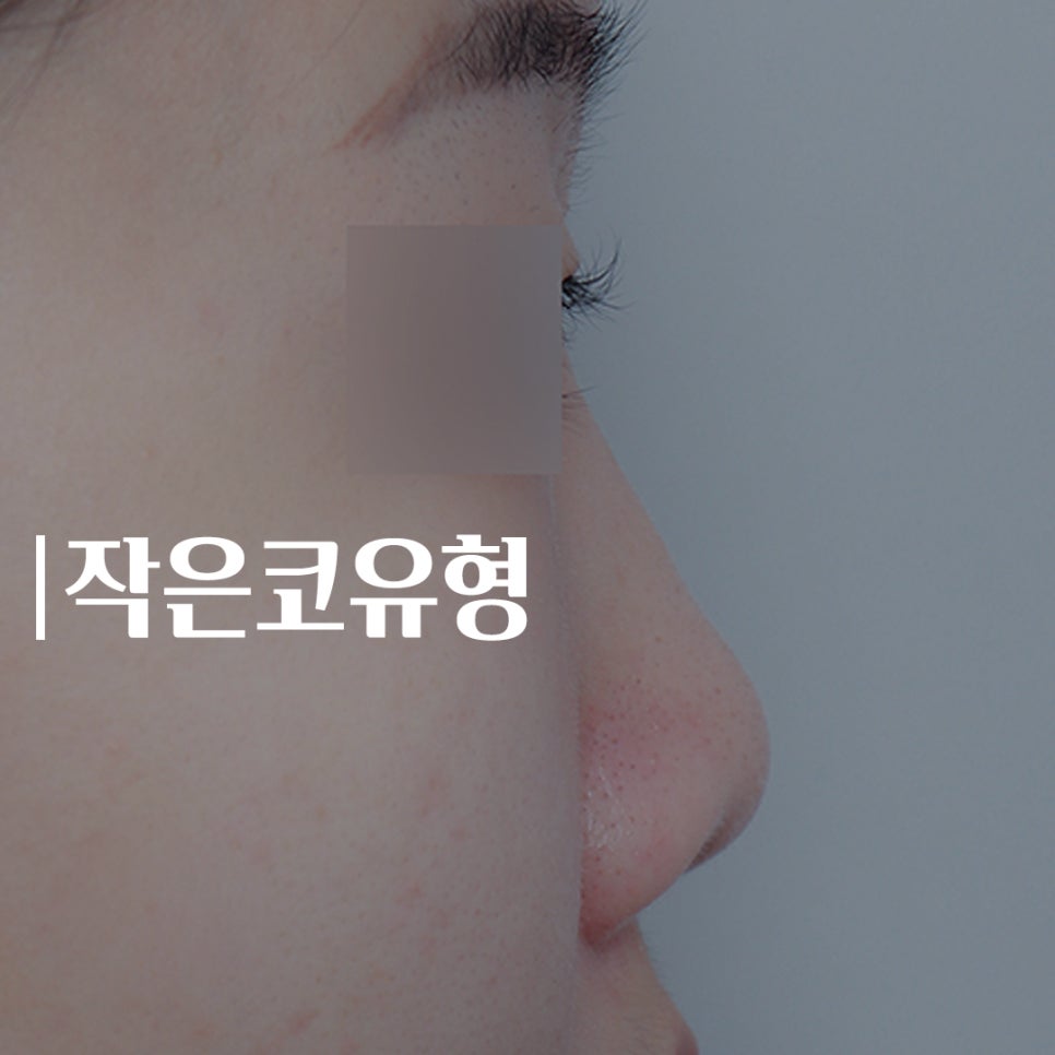 성형하기 힘든 코유형 관련 이미지 2