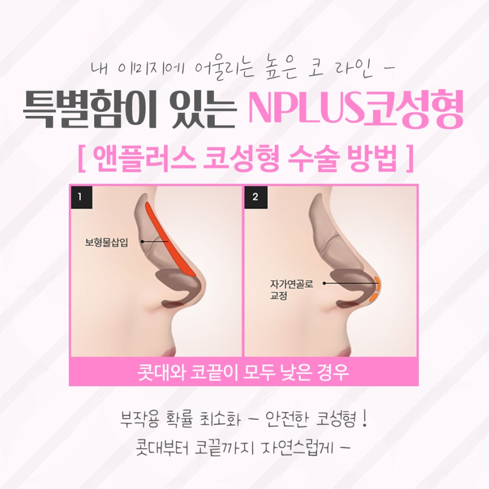 압구정코수술 자연스러운 라인으로 관련 이미지 7