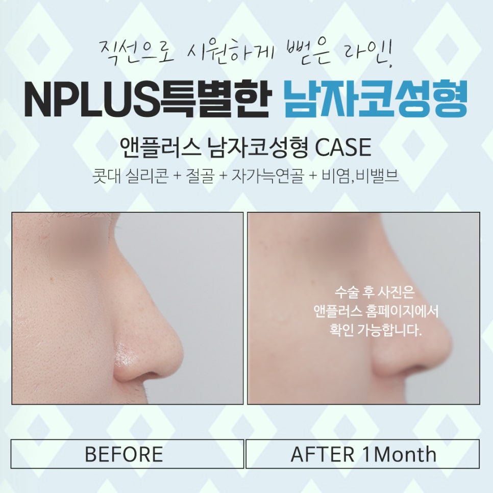 남자코수술전후 라인까지 고려하여 관련 이미지 14