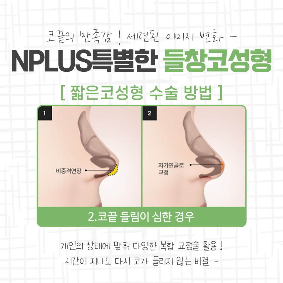 들창코성형 차이를 확인하고 관련 이미지 8