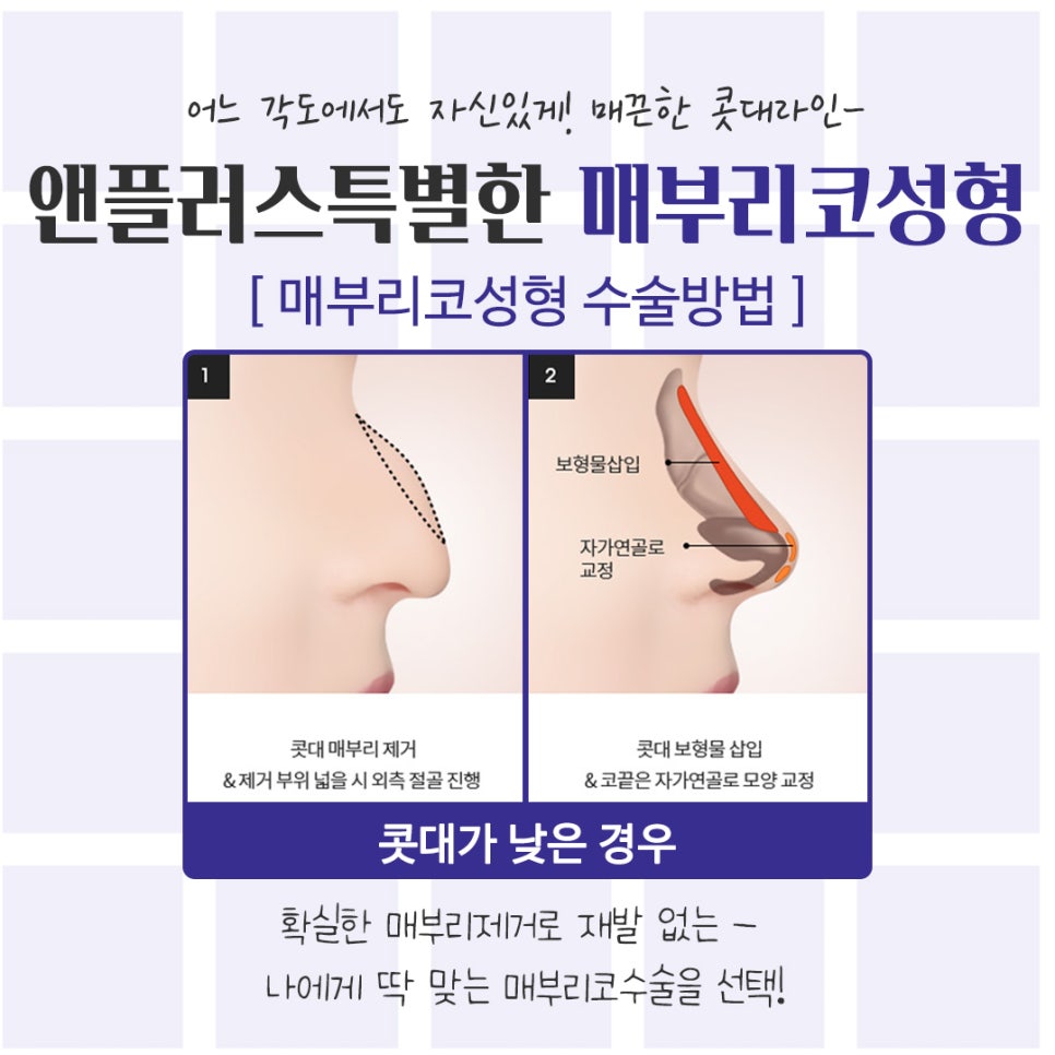 An Image Changed by Hump Nose Surgery Reviews image 10