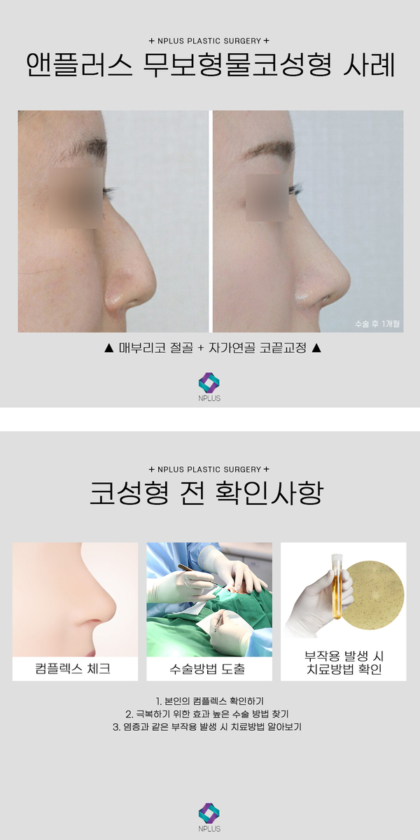 무보형물 코수술 자연스러운 코끝성형 관련 이미지 8