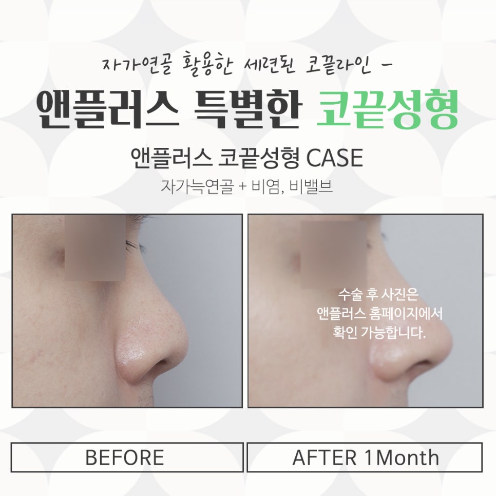 코끝수술후기 자가연골을 통해 자연스럽게 관련 이미지 16