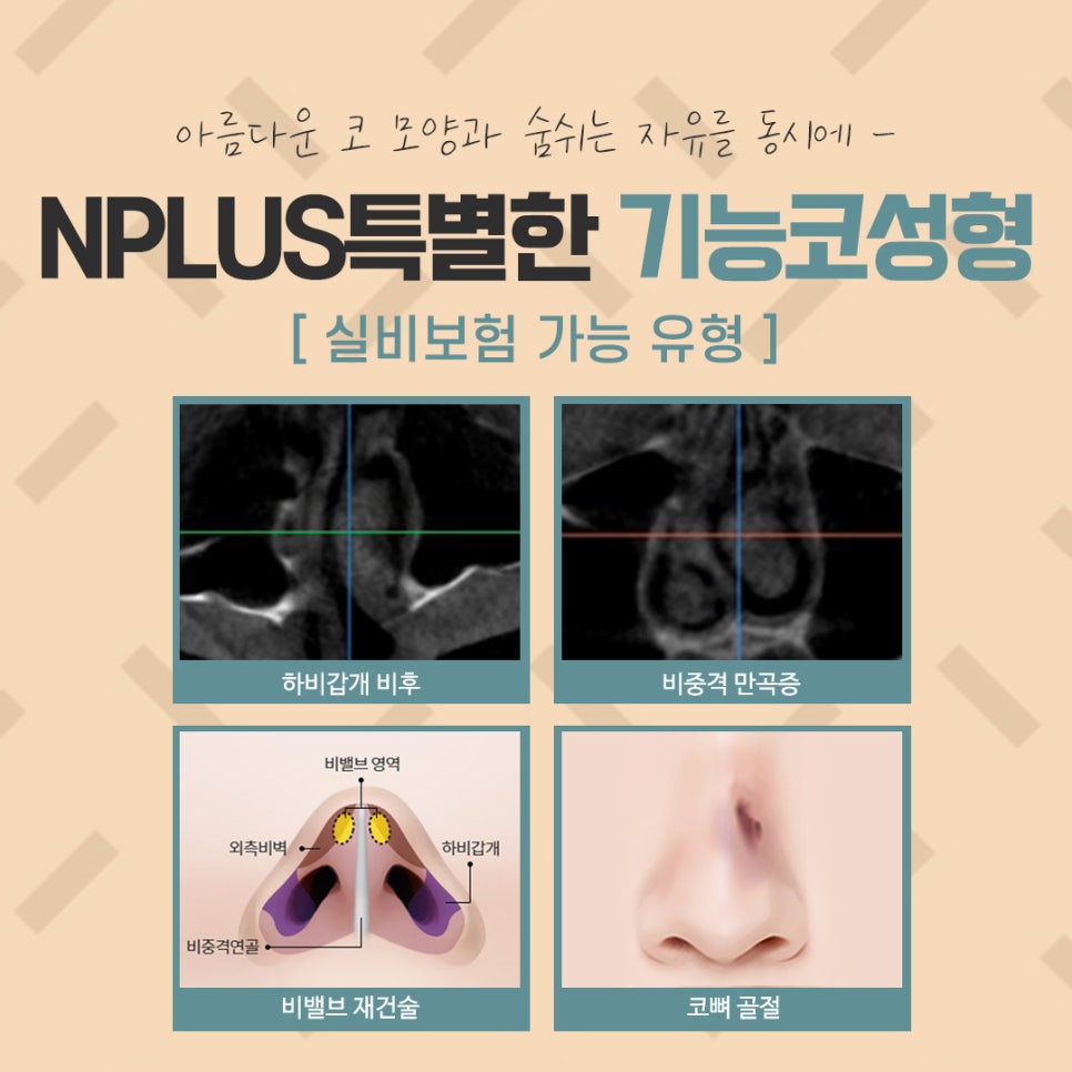 Understanding and Preparing for Functional Rhinoplasty Coverage in Detail image 7