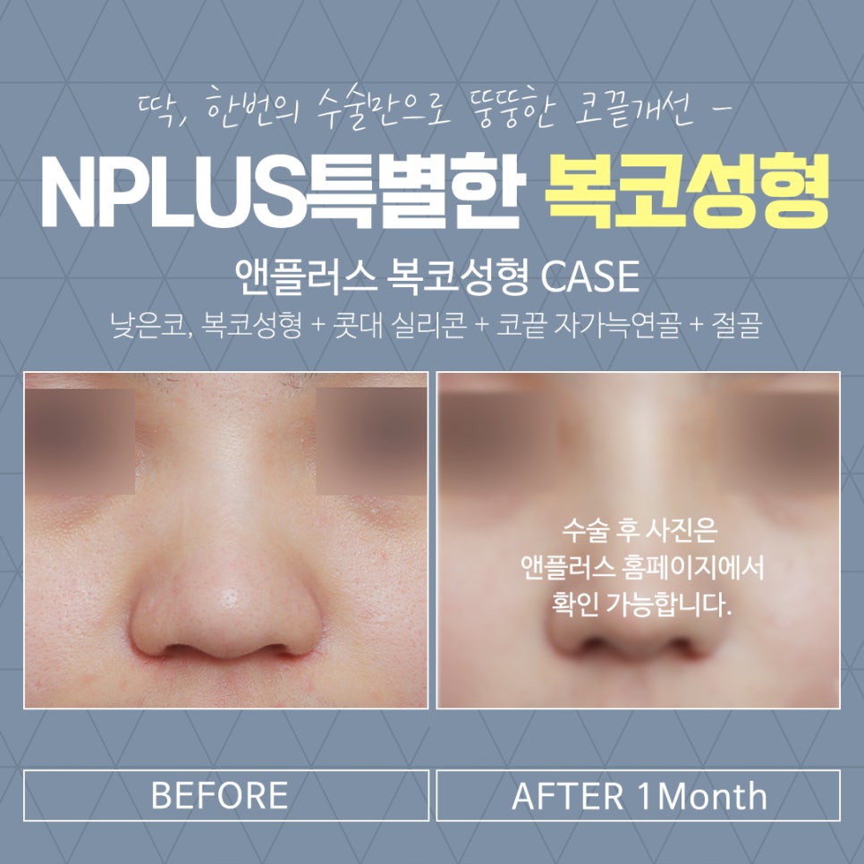복코수술후기를 통해 예쁜 코라인으로 관련 이미지 8