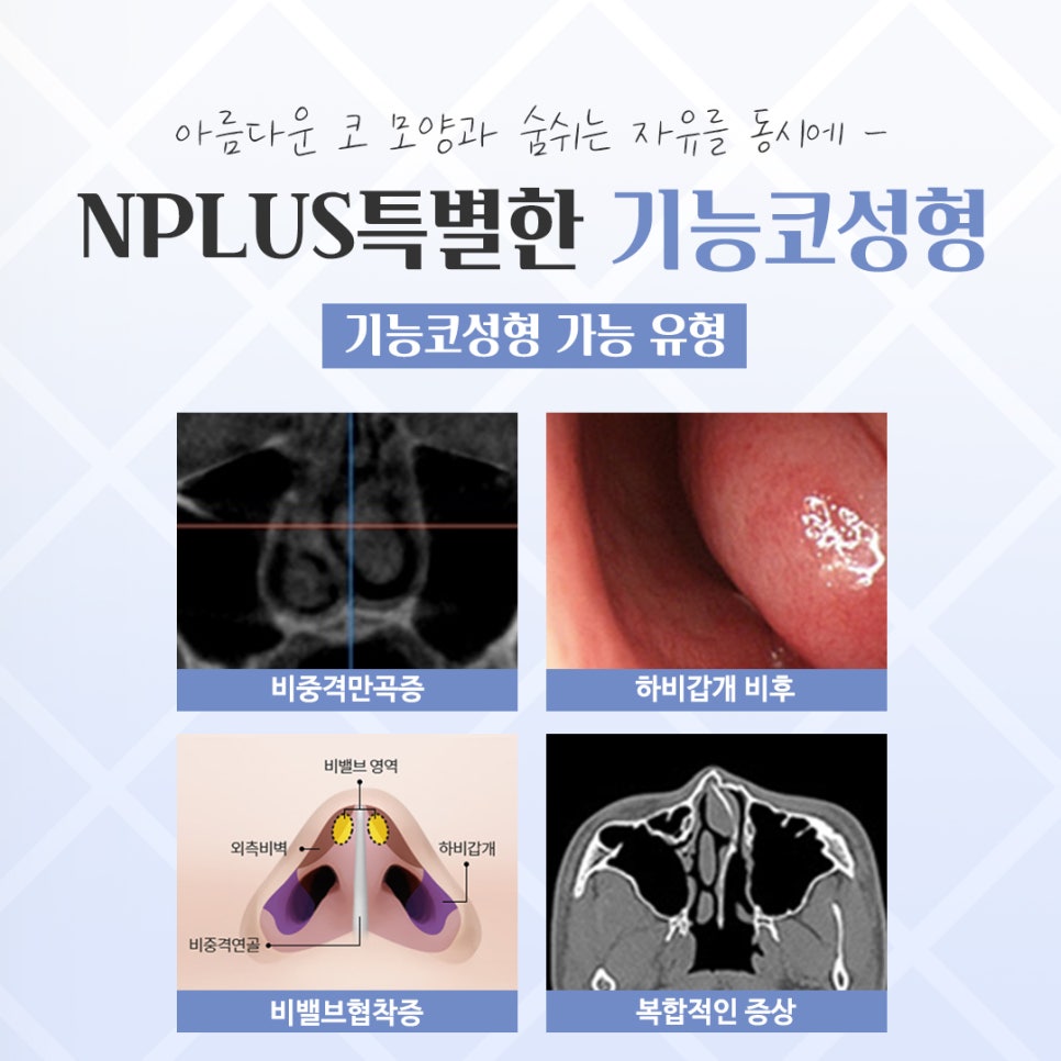 기능코성형 후기 보고 비교하여 관련 이미지 5