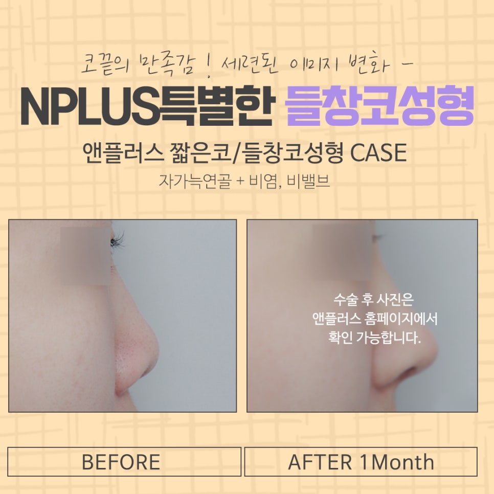 들창코성형 후기까지 알아보고 관련 이미지 13