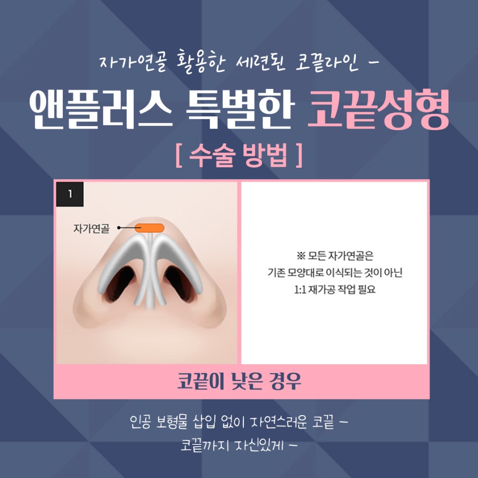 Nose Tip Surgery Review Using Tip Cartilage Suturing image 9
