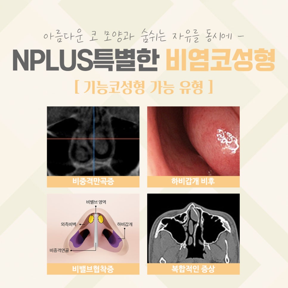 비염코수술후기를 잘 알아보고 관련 이미지 4