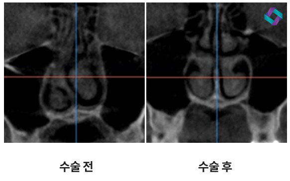 기능코성형 비중격만곡증(비중격교정술)과 코막힘원인 관련 이미지 1