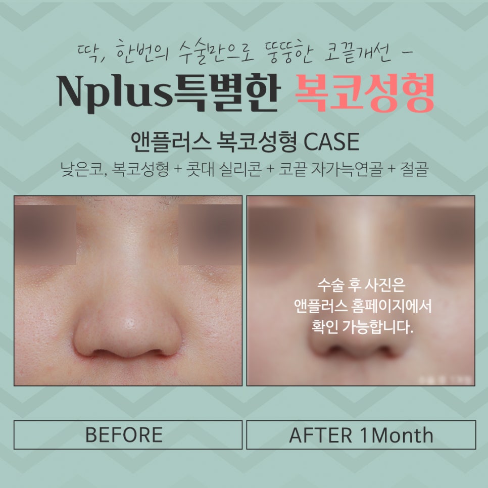 복코수술후기 세련된 인상으로 관련 이미지 7