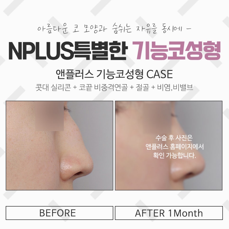 코성형실비를 알아보고 결정 관련 이미지 12