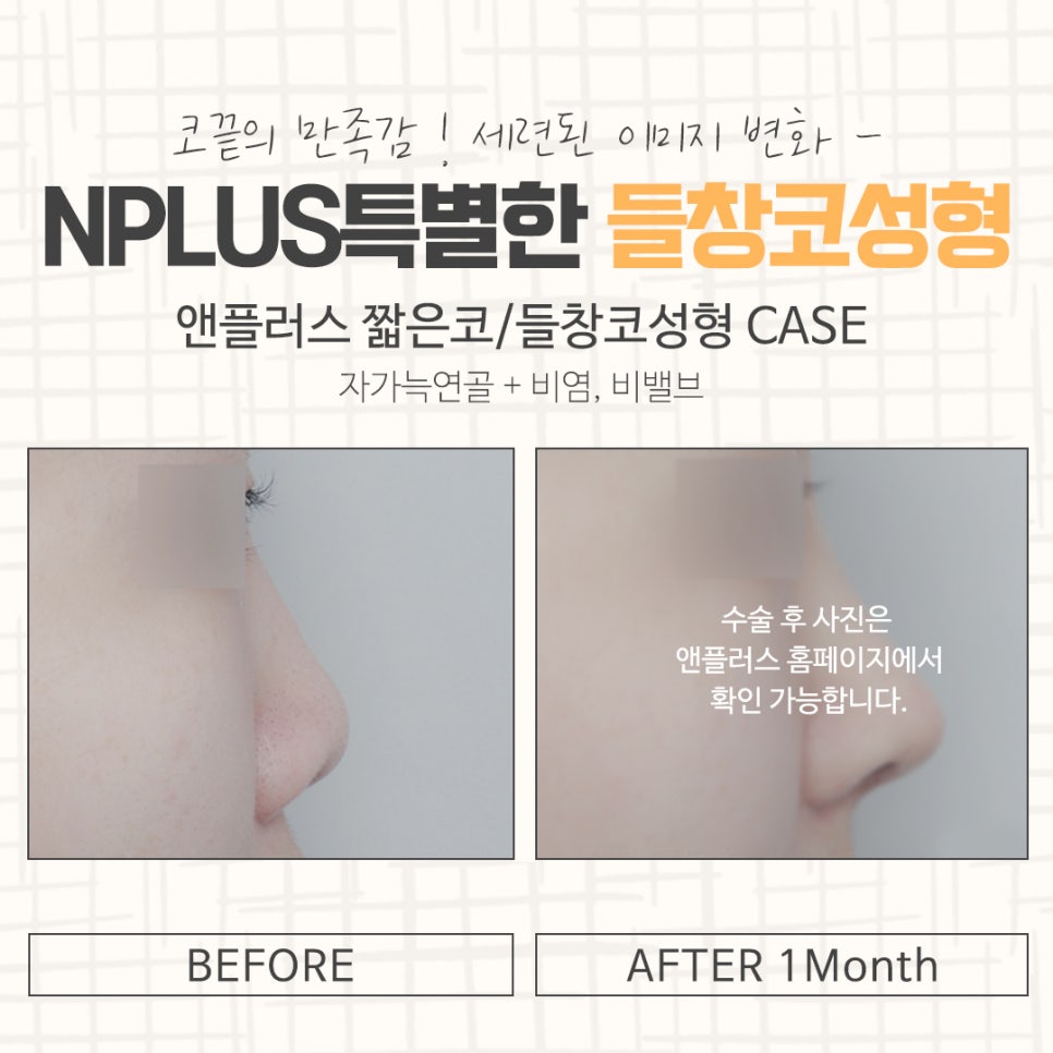 Delicate Upturned Nose Surgery image 15