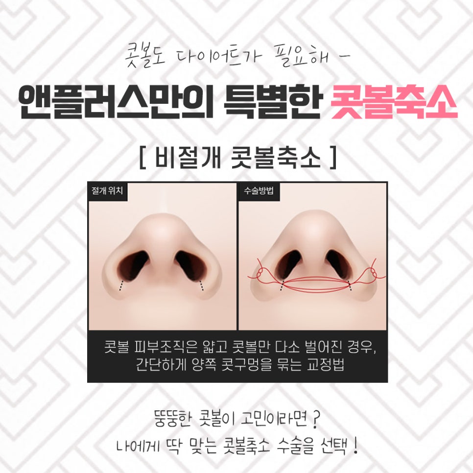 콧볼축소후기 넓은 콧볼이 고민이라면 관련 이미지 9