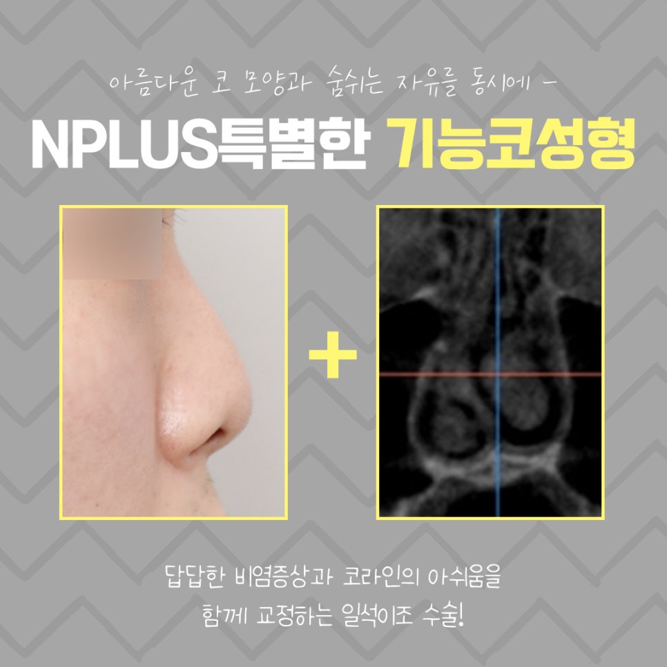 기능코성형을 통한 한쪽 코막힘 개선 관련 이미지 5