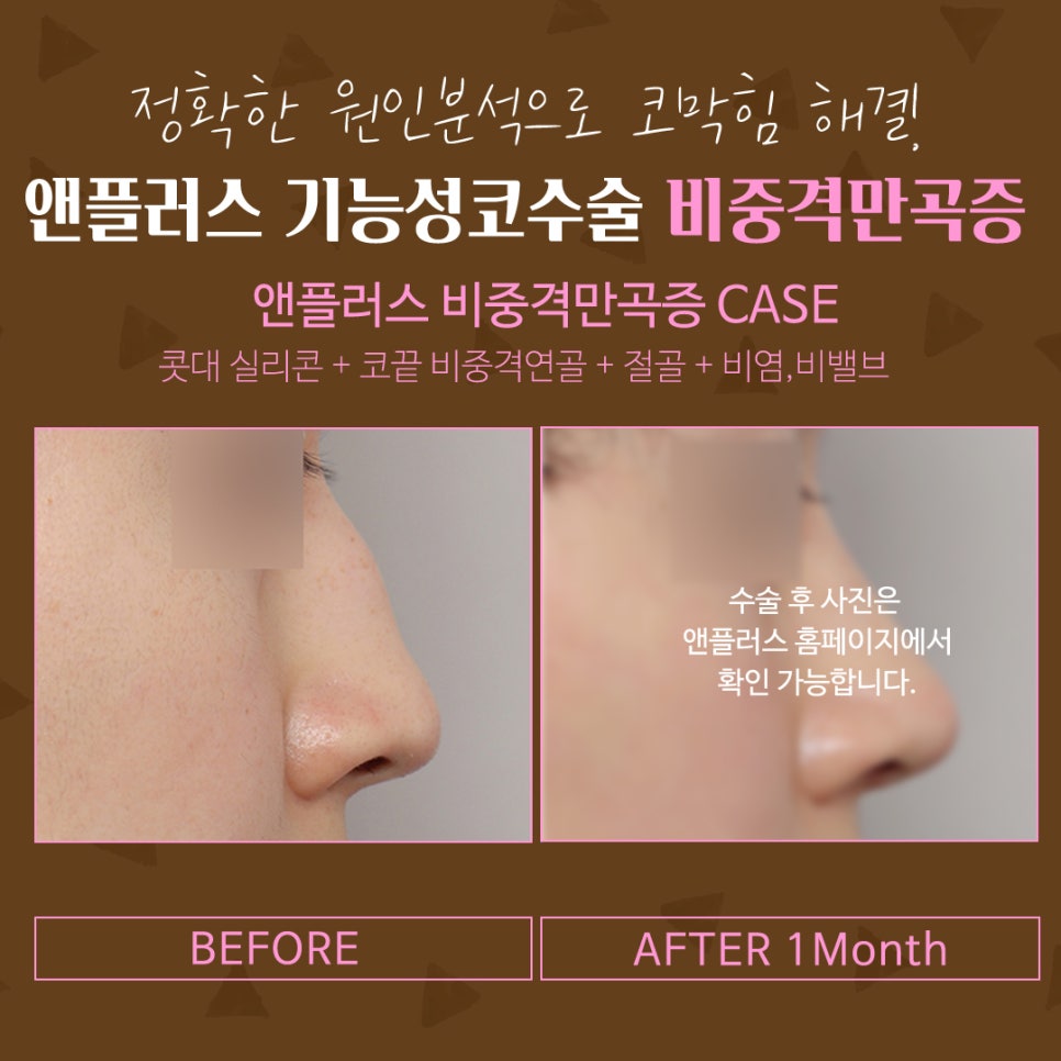 비중격만곡증수술후기 코막힘 고민 해결 관련 이미지 10