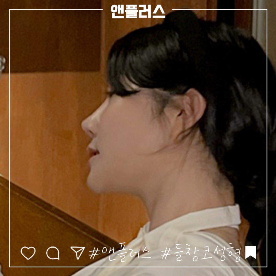 들린코성형 후기를 자세하게 알아보고 관련 이미지 13