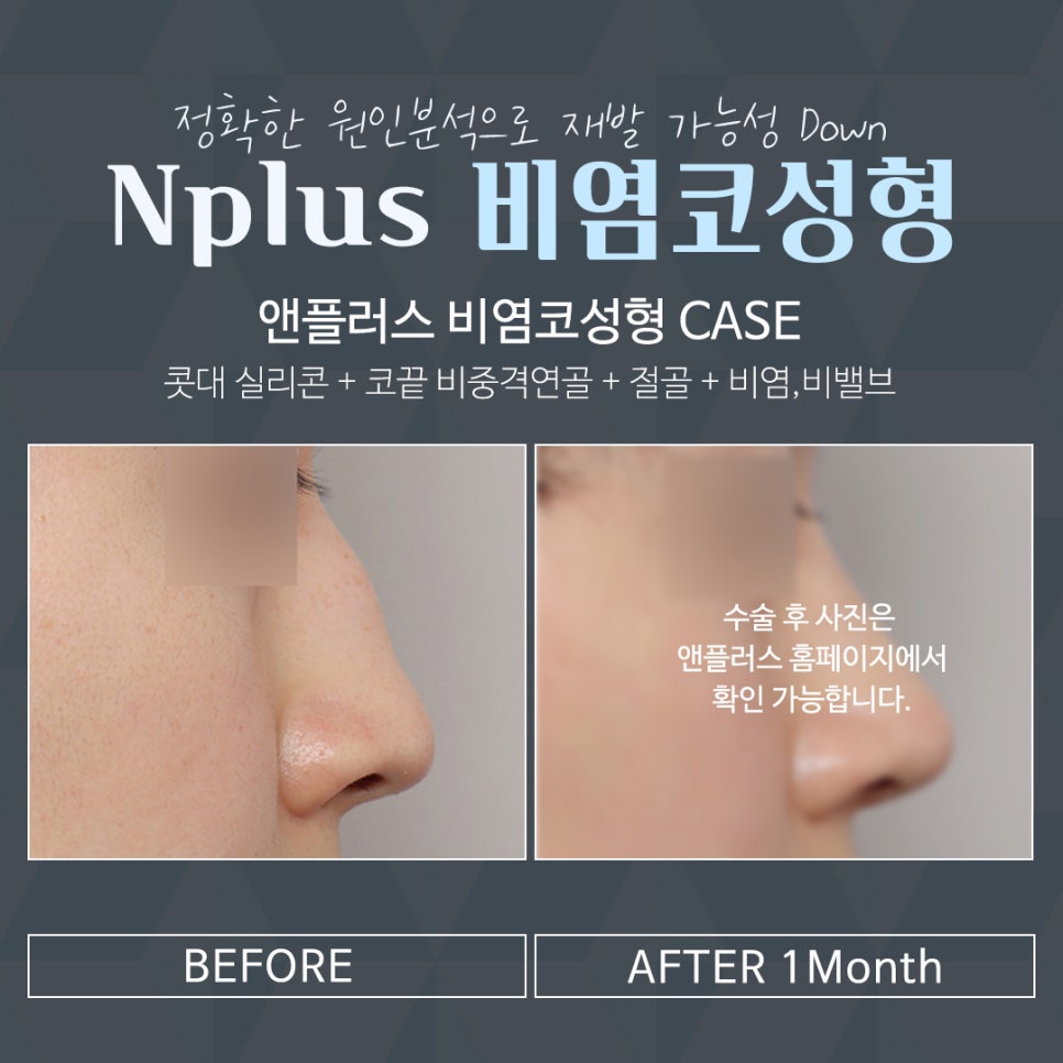 비염수술 방법과 후기까지 관련 이미지 10