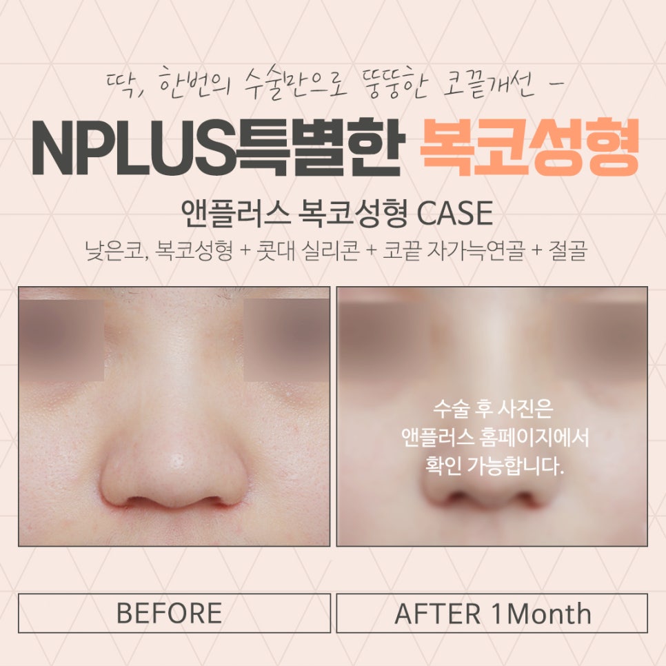 A Clear Bulbous Nose Surgery Review with Nasal Fat Removal image 15