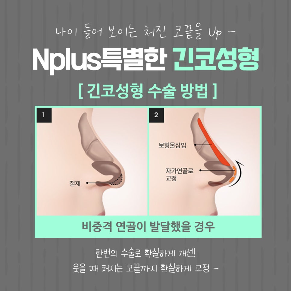 긴코수술 후기까지 확인하고 선택 관련 이미지 10