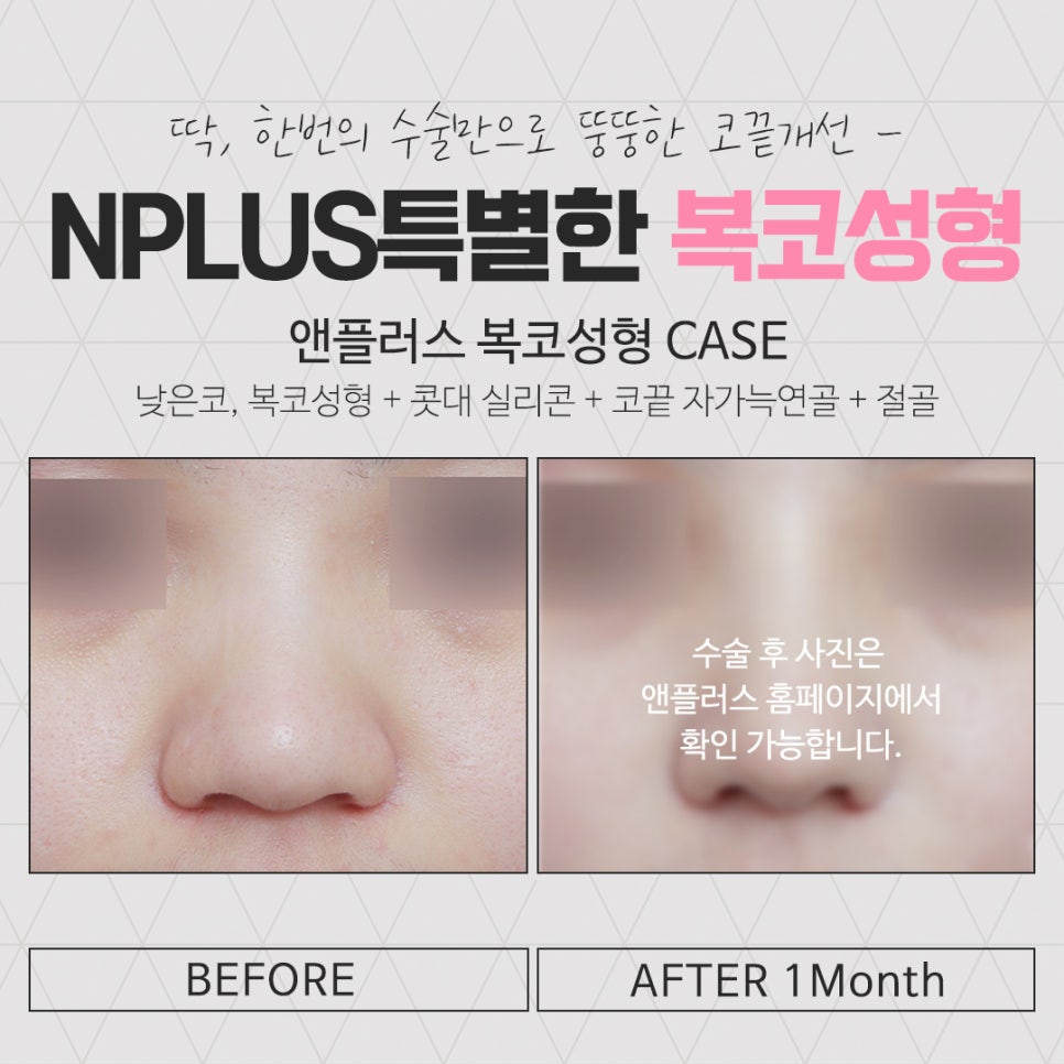 복코성형 세련된 이미지로 관련 이미지 16