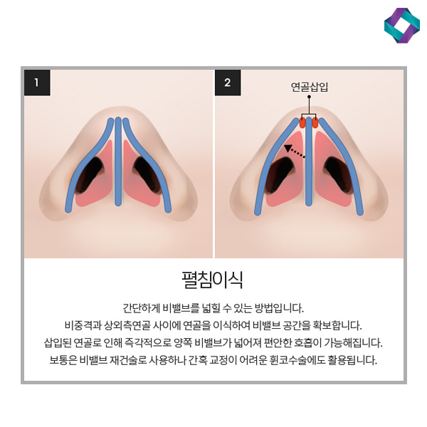 비염수술코성형 비밸브 교정술! 관련 이미지 7