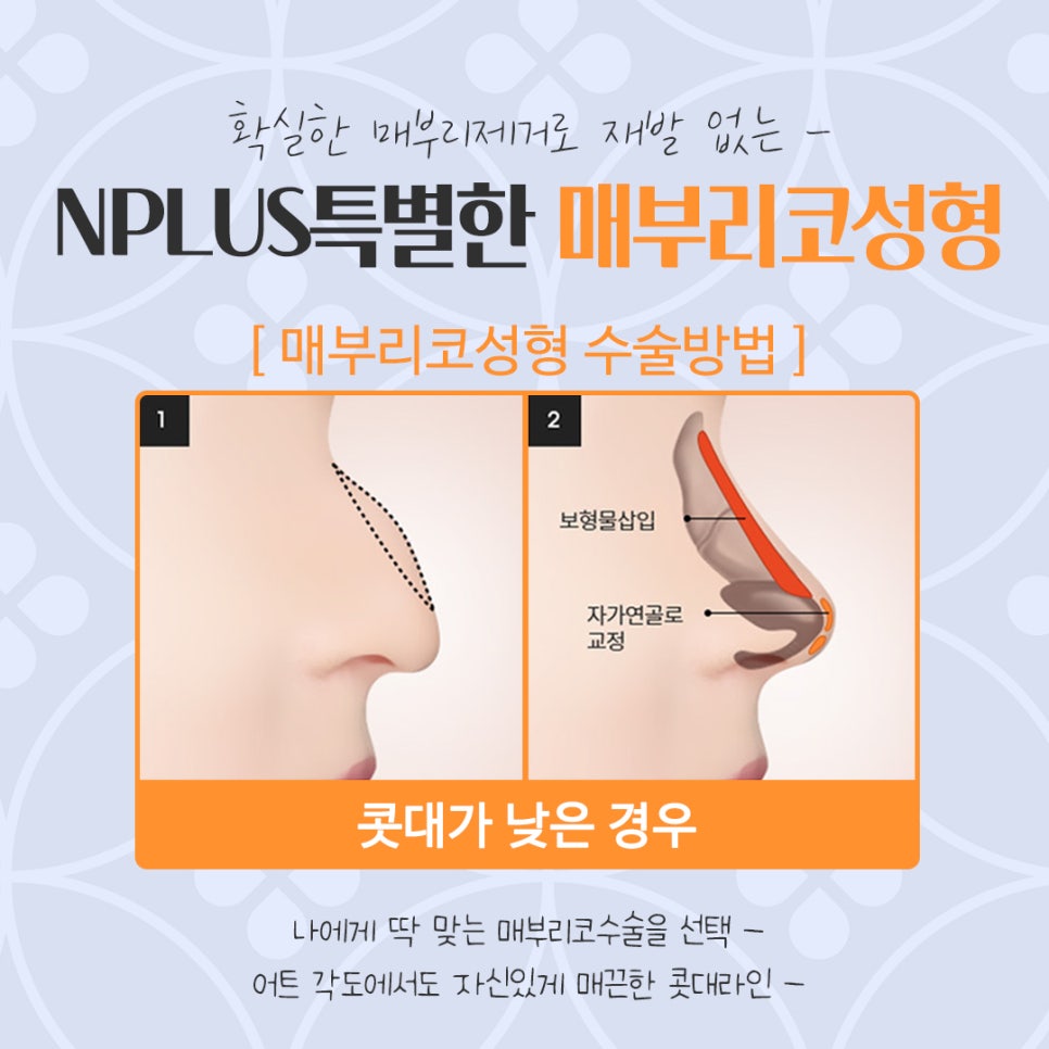 매부리코성형후기 매부리코 잘하는 곳에서 관련 이미지 11