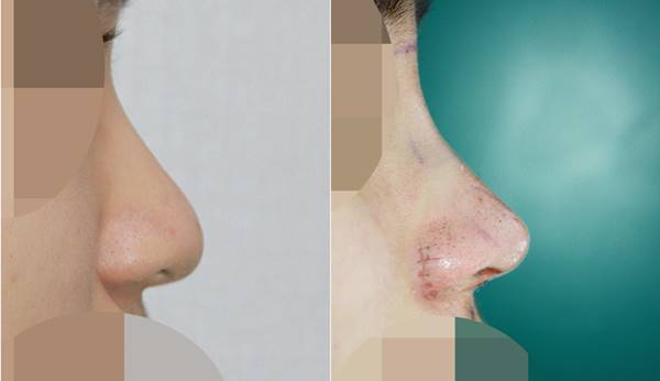 코성형잘하는곳_복코수술 전후 관련 이미지 1