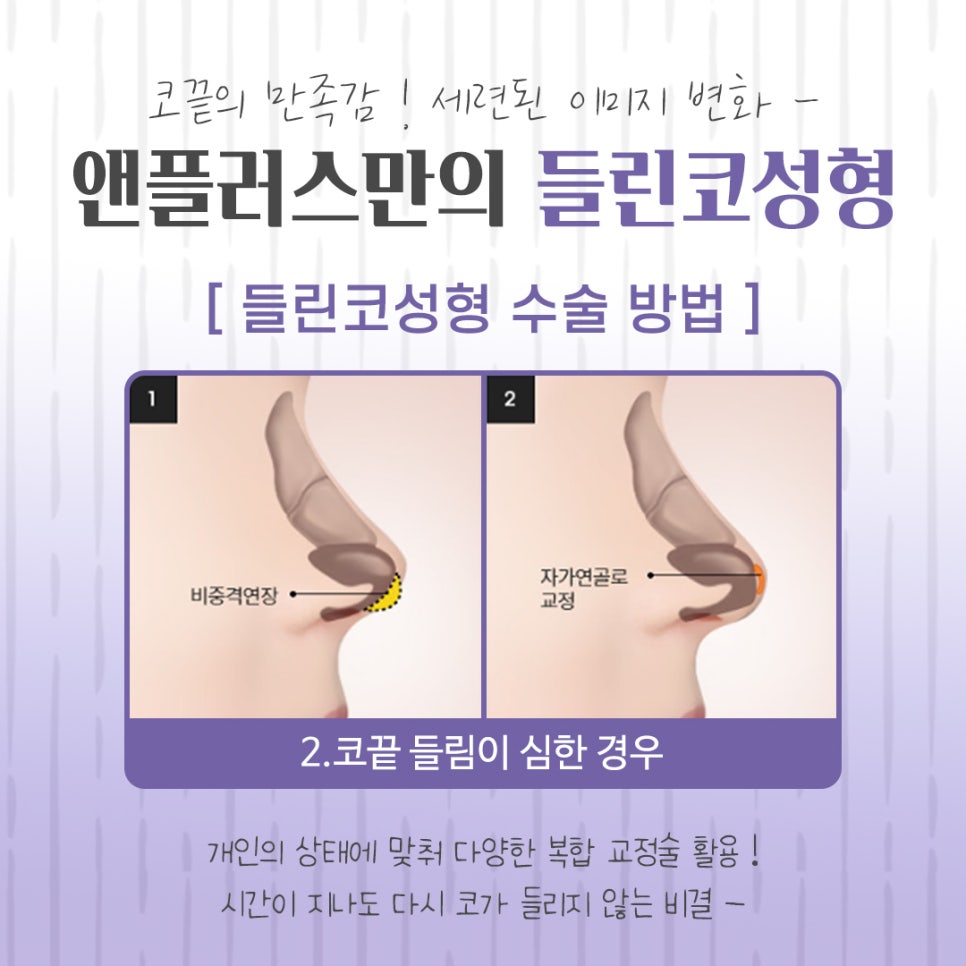 들린코성형 후기를 자세하게 알아보고 관련 이미지 10