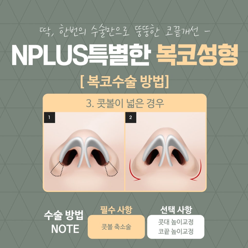 복코성형으로 세련된 이미지 변신 관련 이미지 11