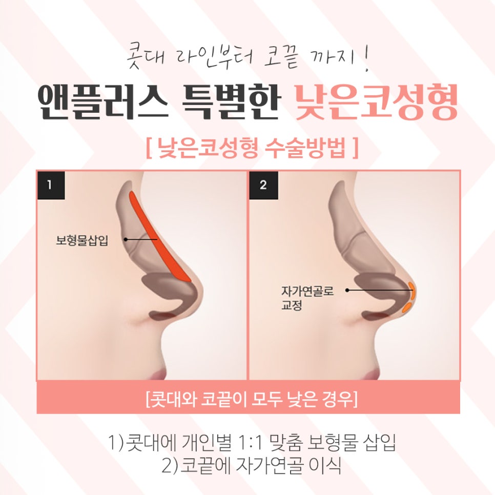낮은코수술을 통해 날렵하고 세련된 이미지로 관련 이미지 7