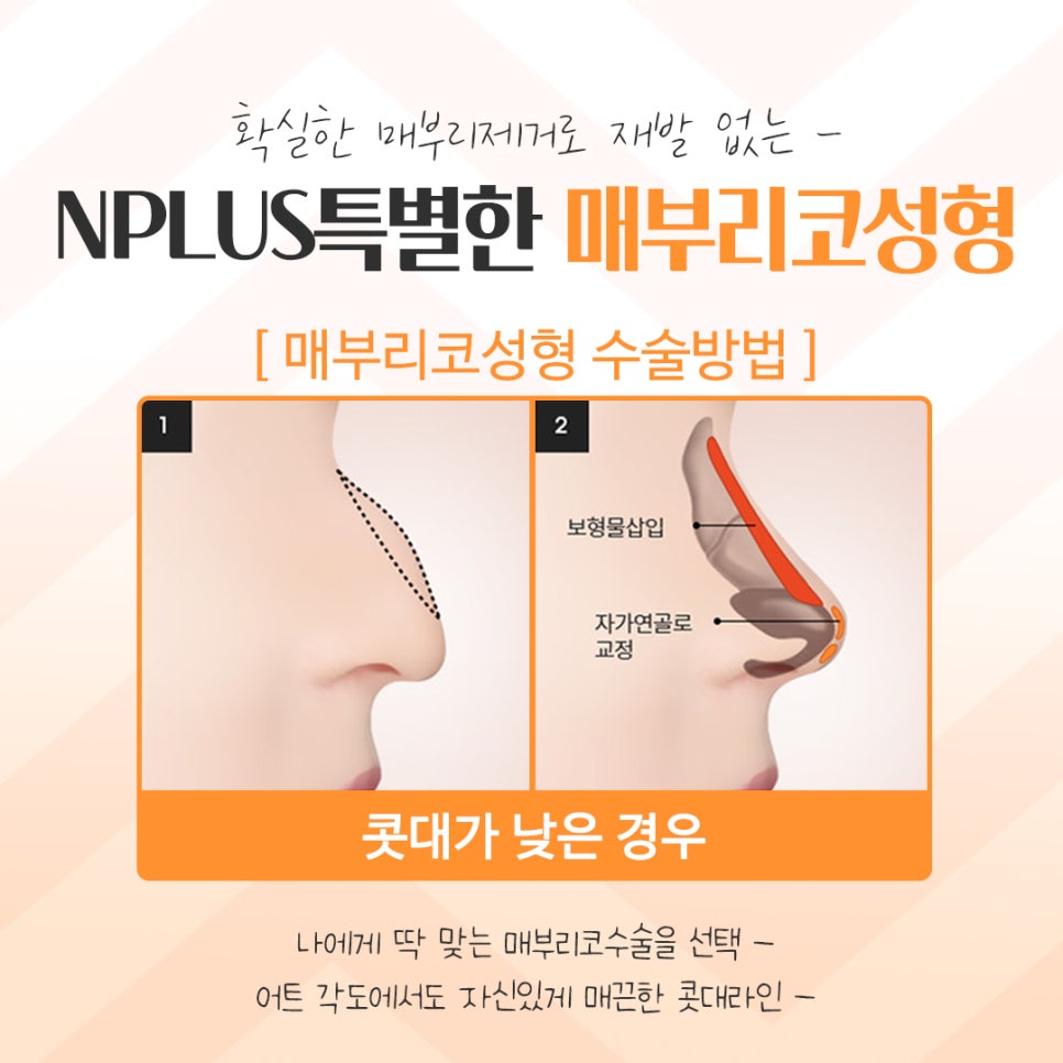 매부리코성형후기를 자세하게 알아보고 관련 이미지 9