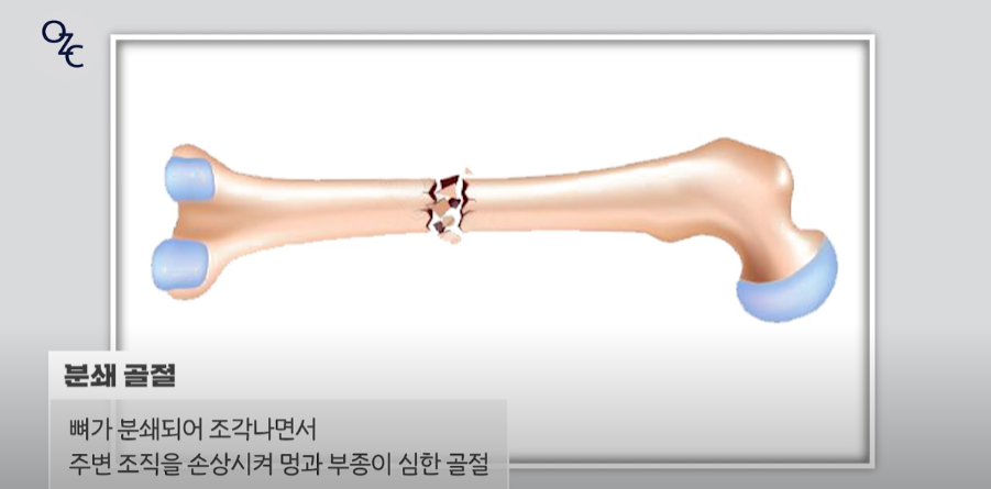 코뼈골절의 원인과 수술 방법에 대하여 관련 이미지 17