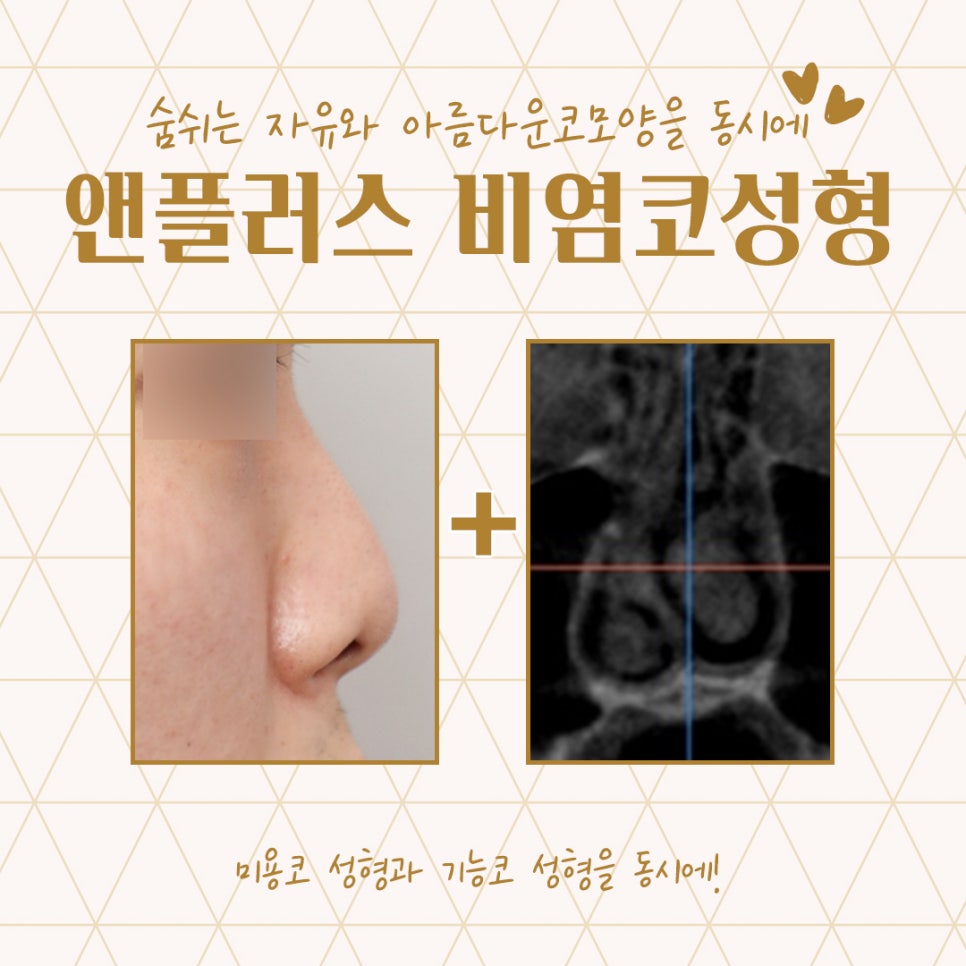 비염코성형후기 예쁜코라인을 생각하면서 관련 이미지 4