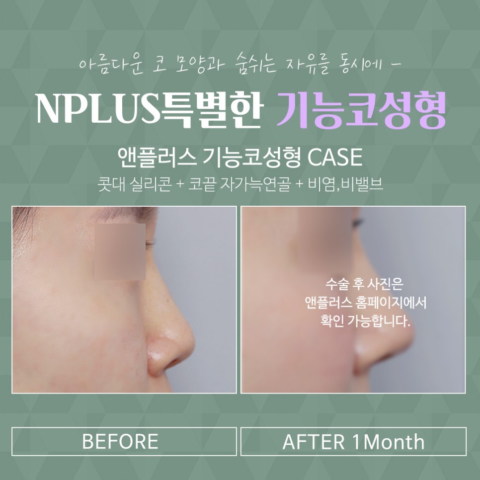 코수술후기 라인까지 고려해서 관련 이미지 4