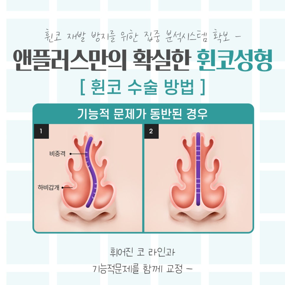Understanding the Issues in Crooked Nose Surgery Accurately image 9