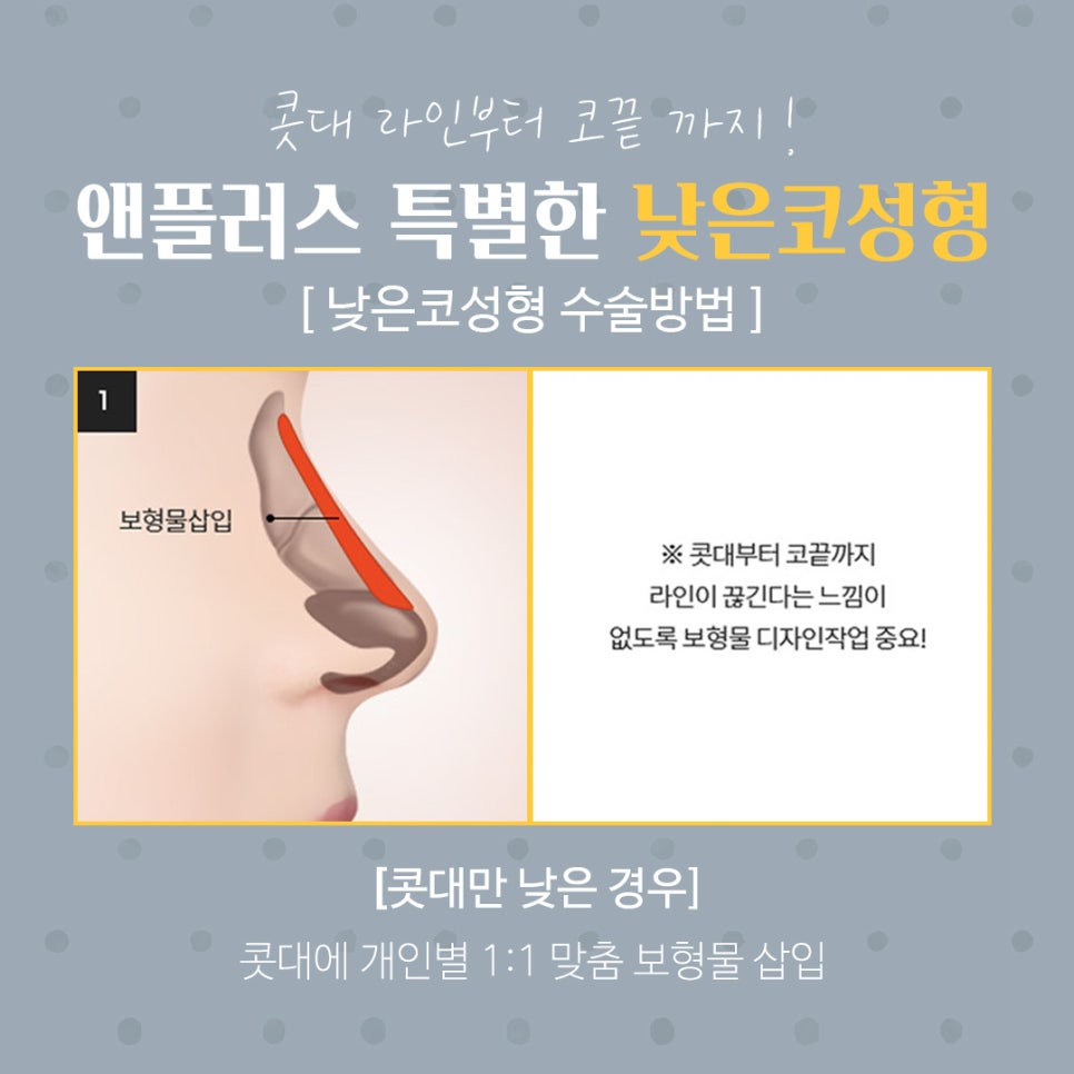 Transforming a Low Nose with a Beautiful Nose Line image 8