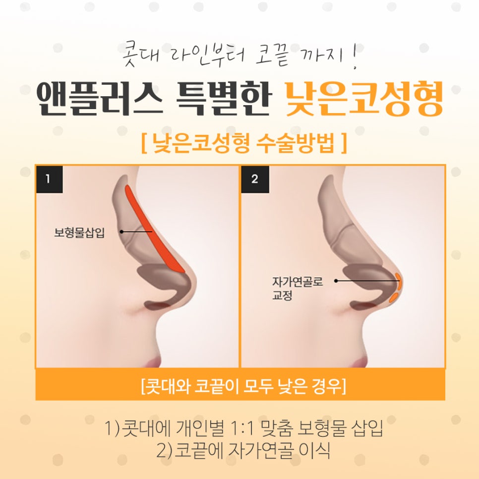 낮은코성형후기를 자세하게 찾아보고 관련 이미지 5