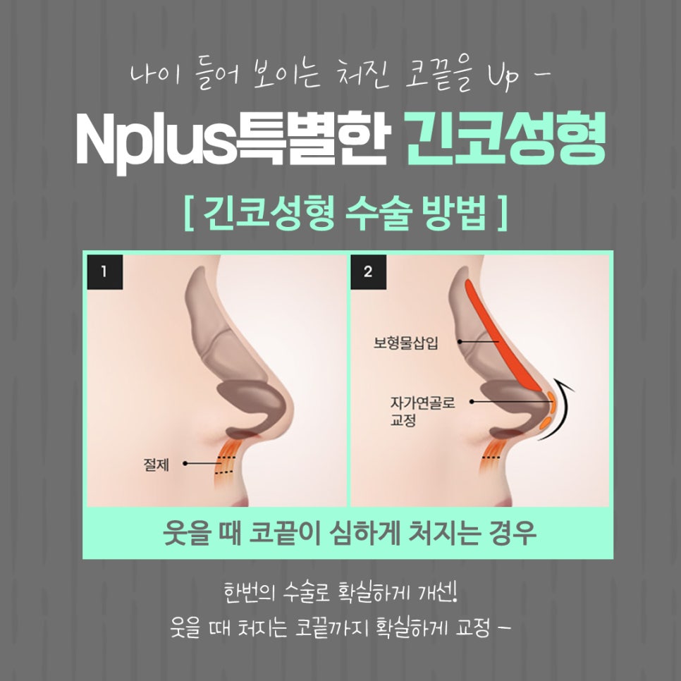 긴코수술 후기까지 확인하고 선택 관련 이미지 12