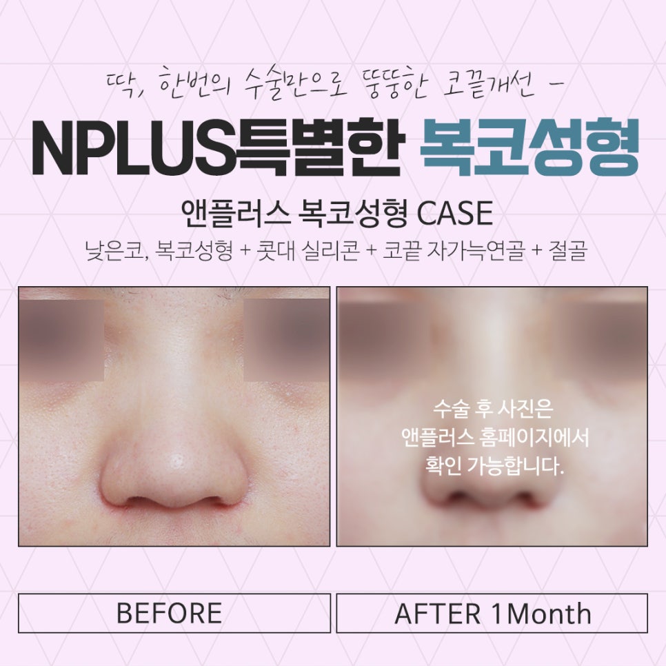 Be Sure to Learn About Bulbous Nose Surgery Reviews image 17
