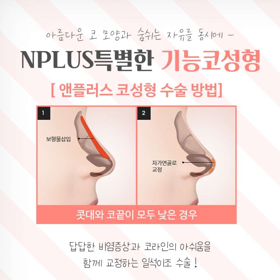 기능코성형후기 다양한 정보를 알아보고 관련 이미지 10