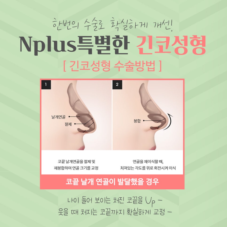 Long Nose Surgery: From Looking Older to Looking Younger image 8