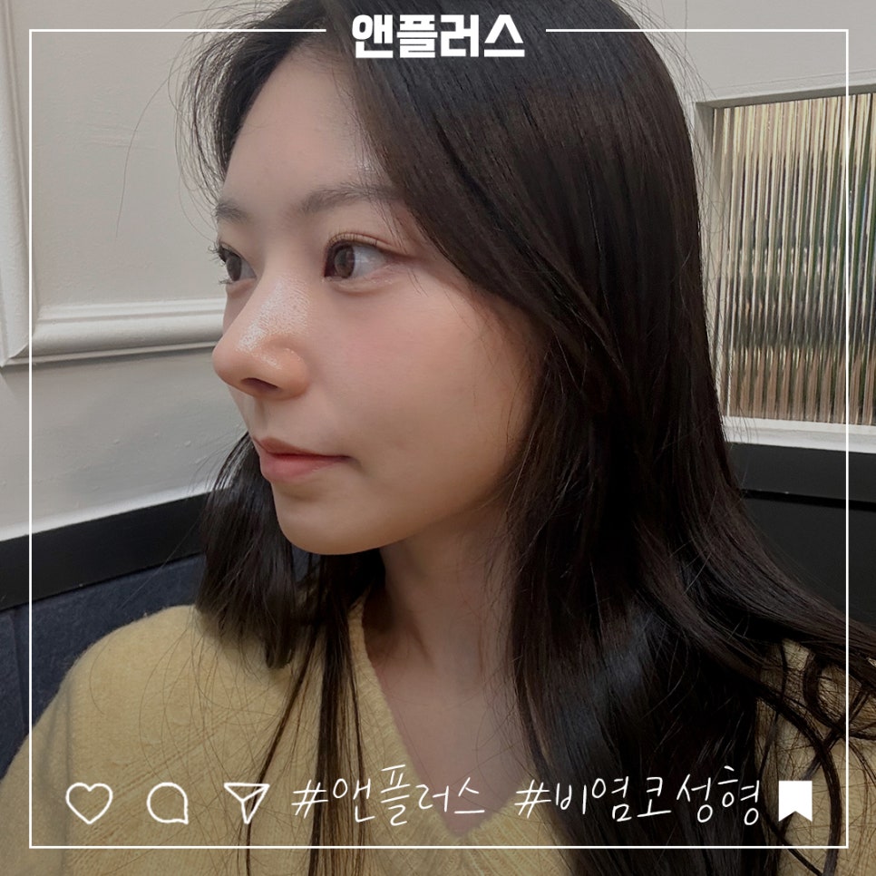 앤플러스에서 진행된 비염수술코성형에 대하여 관련 이미지 10